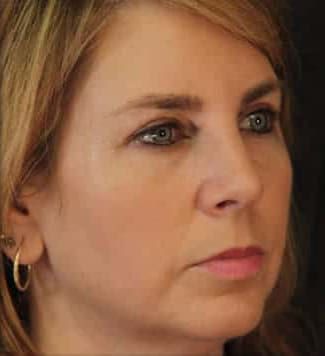 Eyelid Surgery Before & After