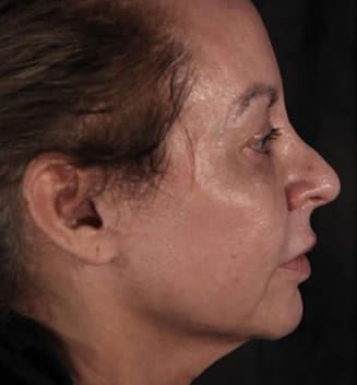 Eyelid Surgery Before & After