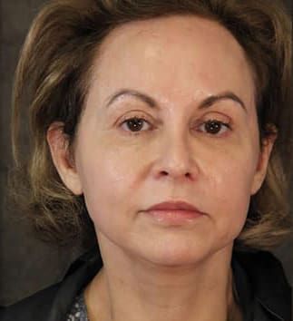 Eyelid Surgery Before & After