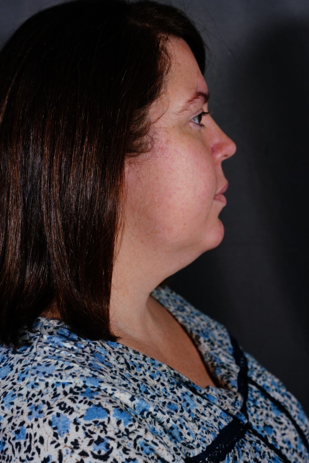 Eyelid Surgery Before & After