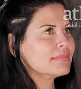 Eyelid Surgery Before & After