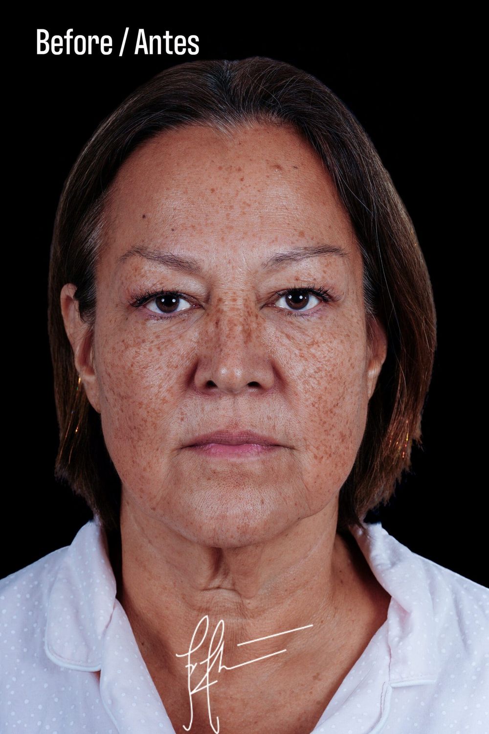 Eyelid Surgery Before & After