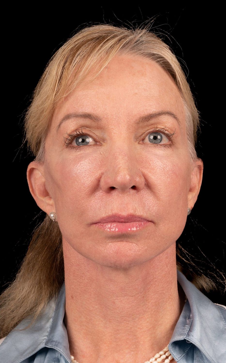 Eyelid Surgery Before & After