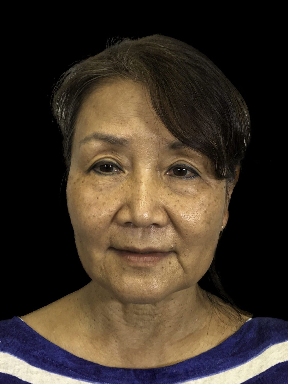 Eyelid Surgery Before & After