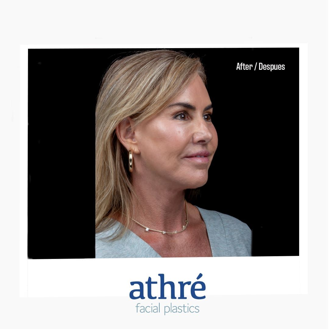 Eyelid Surgery Before & After