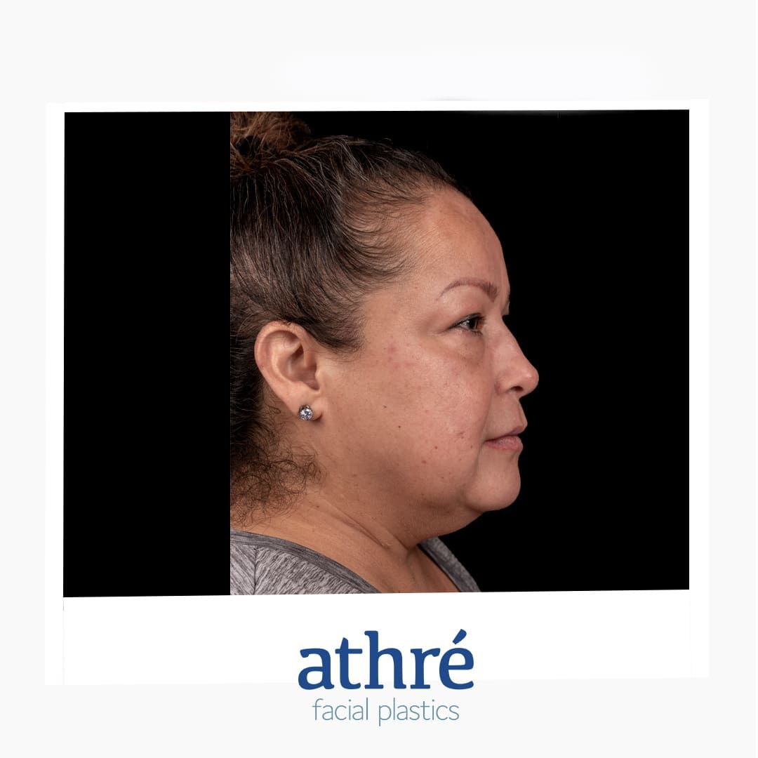 Eyelid Surgery Before & After