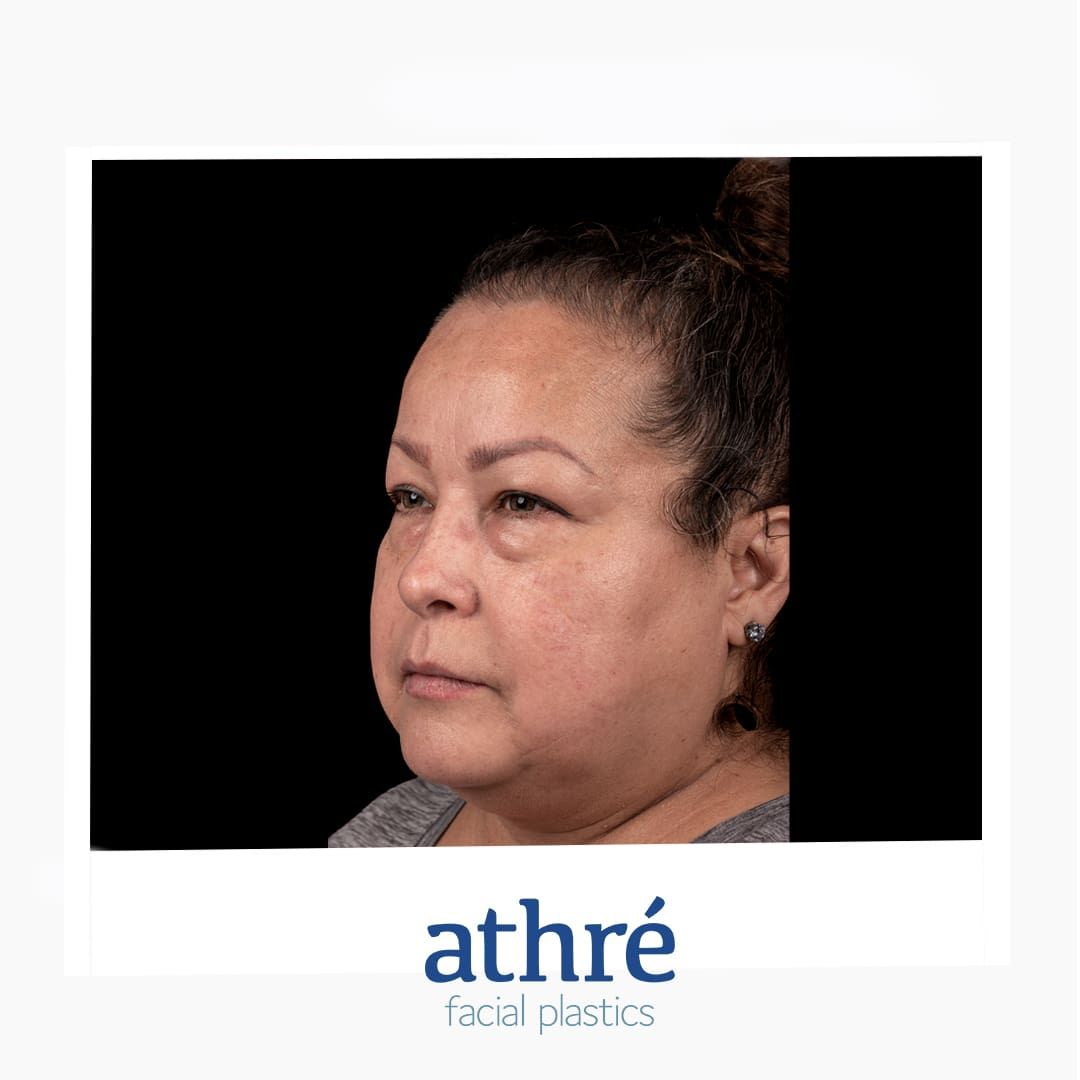 Eyelid Surgery Before & After