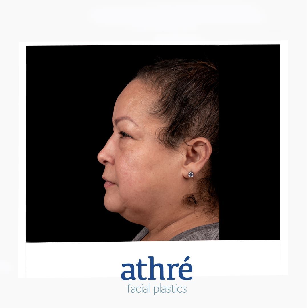 Eyelid Surgery Before & After