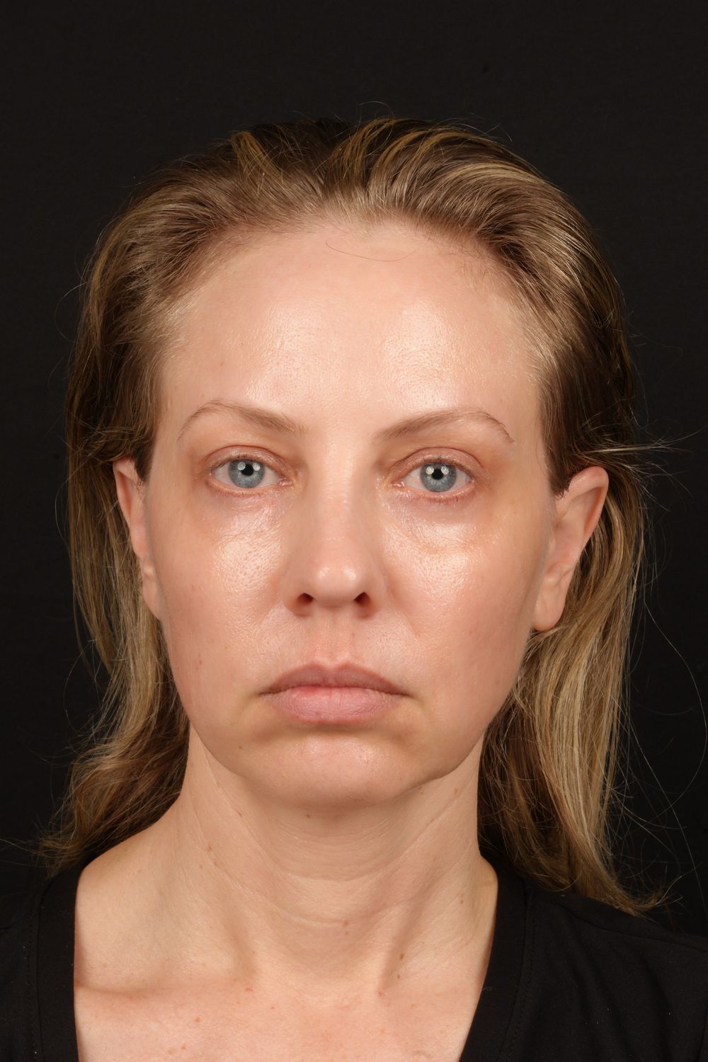 Eyelid Surgery Before & After