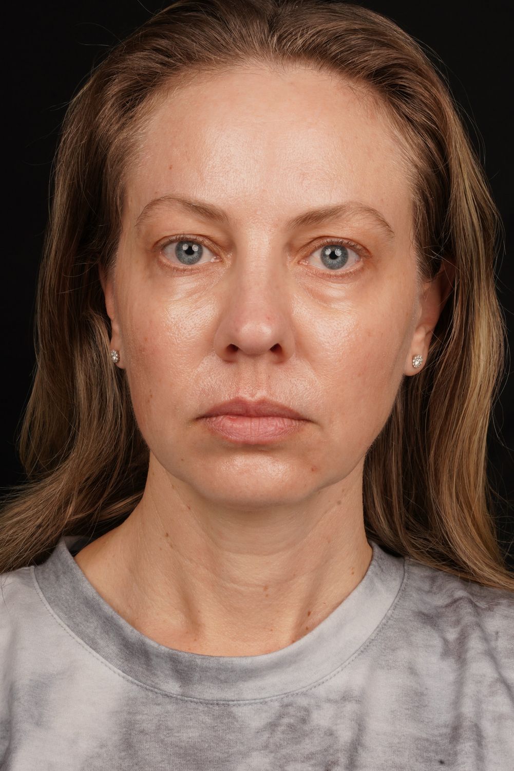 Eyelid Surgery Before & After