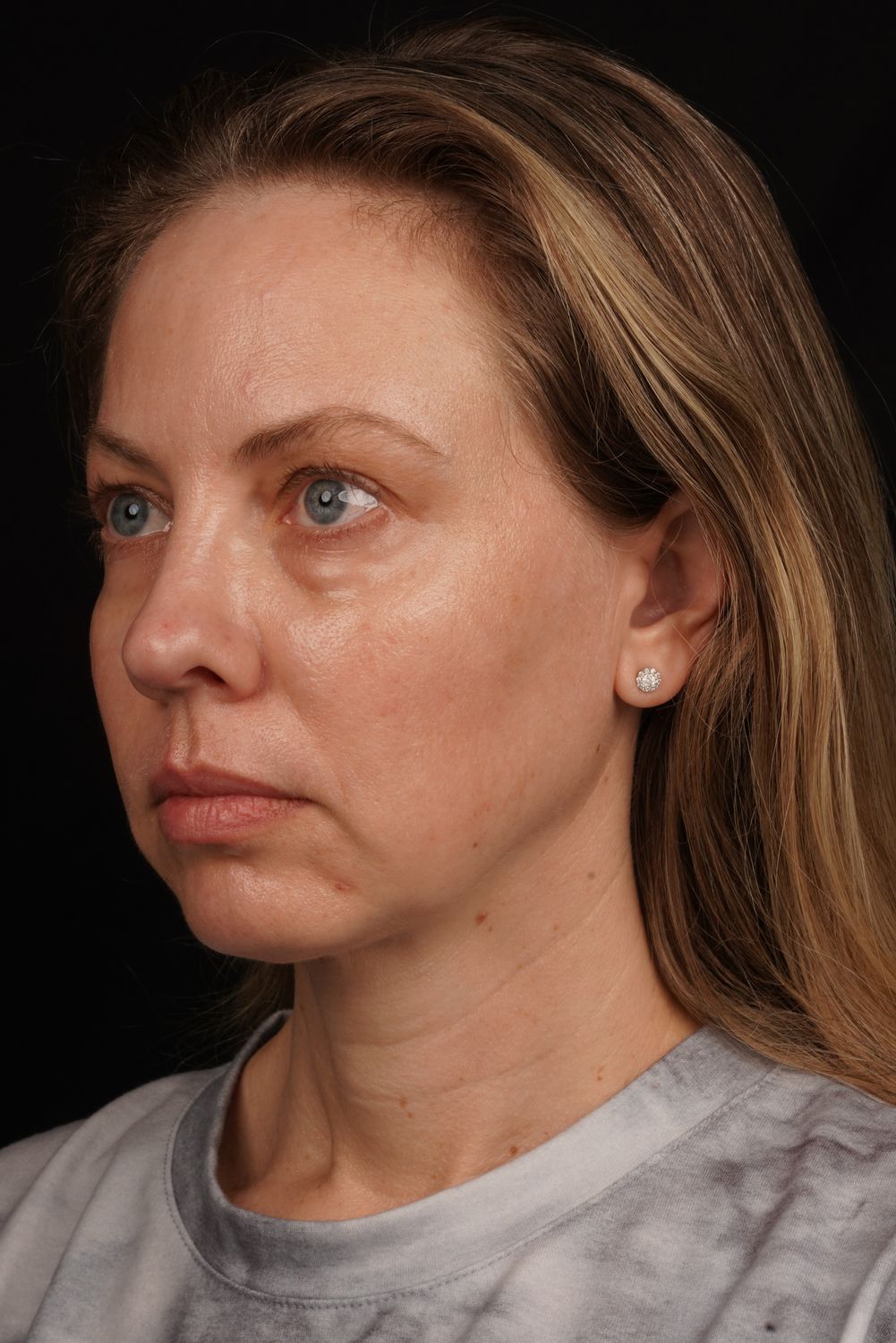 Eyelid Surgery Before & After