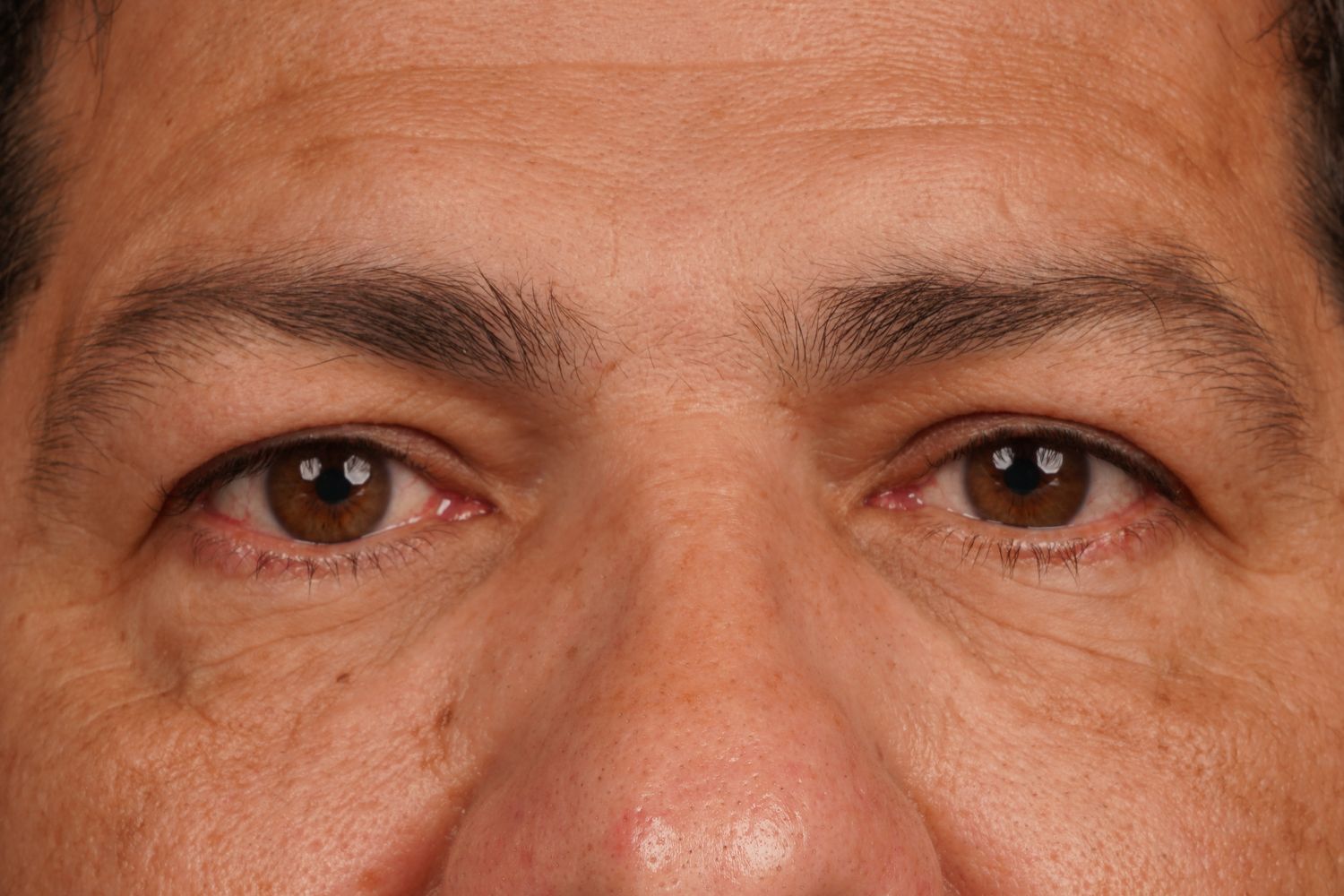 Eyelid Surgery Before & After