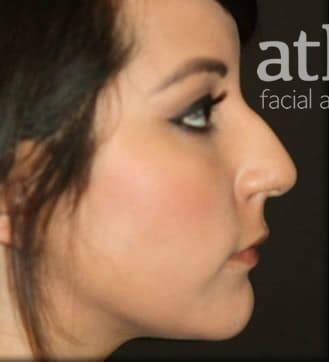 Rhinoplasty Before & After