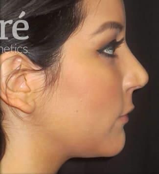 Rhinoplasty Before & After