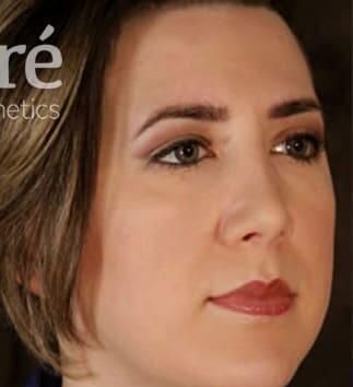 Rhinoplasty Before & After