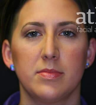 Rhinoplasty Before & After