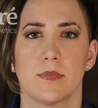 Rhinoplasty Before & After