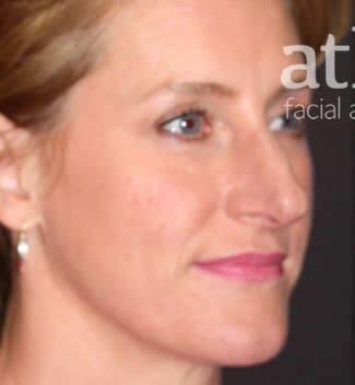 Rhinoplasty Before & After