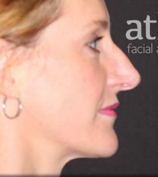 Rhinoplasty Before & After