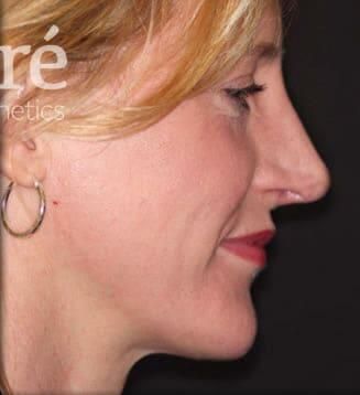 Rhinoplasty Before & After