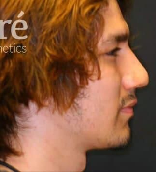 Rhinoplasty Before & After