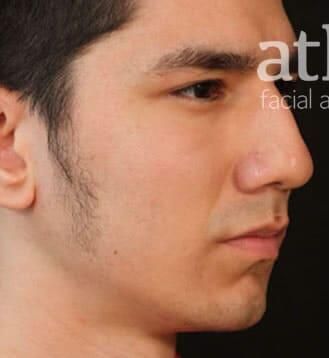 Rhinoplasty Before & After