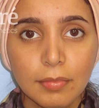 Rhinoplasty Before & After