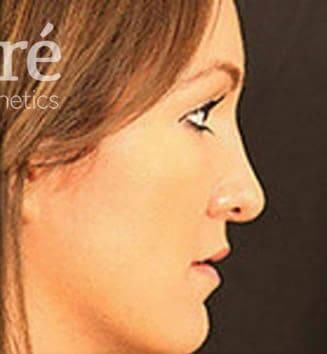 Rhinoplasty Before & After
