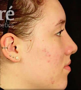 Rhinoplasty Before & After