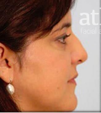 Rhinoplasty Before & After