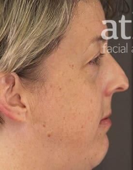 Rhinoplasty Before & After