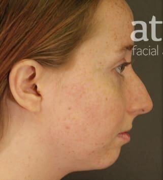Rhinoplasty Before & After