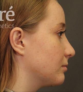 Rhinoplasty Before & After