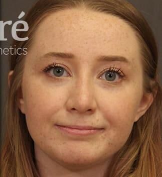 Rhinoplasty Before & After