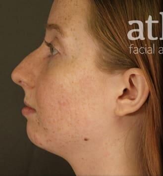 Rhinoplasty Before & After