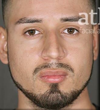 Rhinoplasty Before & After