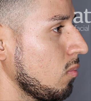 Rhinoplasty Before & After