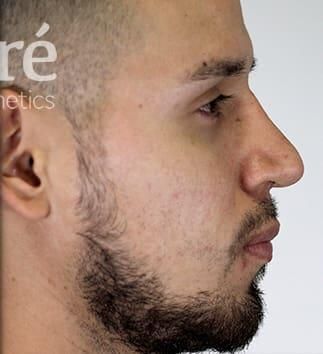 Rhinoplasty Before & After