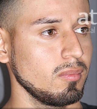 Rhinoplasty Before & After