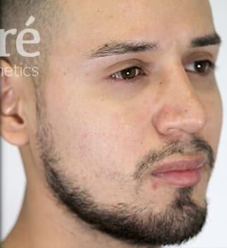 Rhinoplasty Before & After