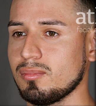 Rhinoplasty Before & After