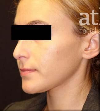 Rhinoplasty Before & After