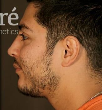 Rhinoplasty Before & After