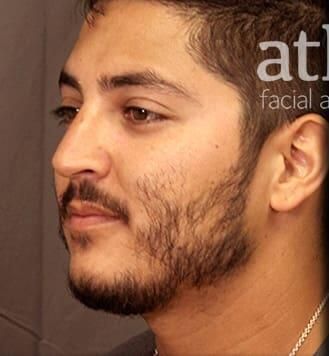 Rhinoplasty Before & After