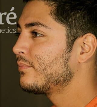 Rhinoplasty Before & After