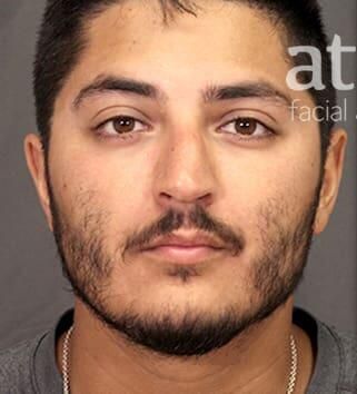 Rhinoplasty Before & After