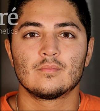 Rhinoplasty Before & After