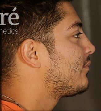 Rhinoplasty Before & After