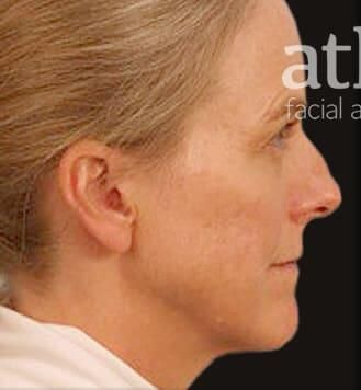 Rhinoplasty Before & After