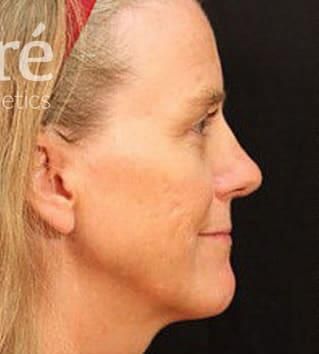 Rhinoplasty Before & After